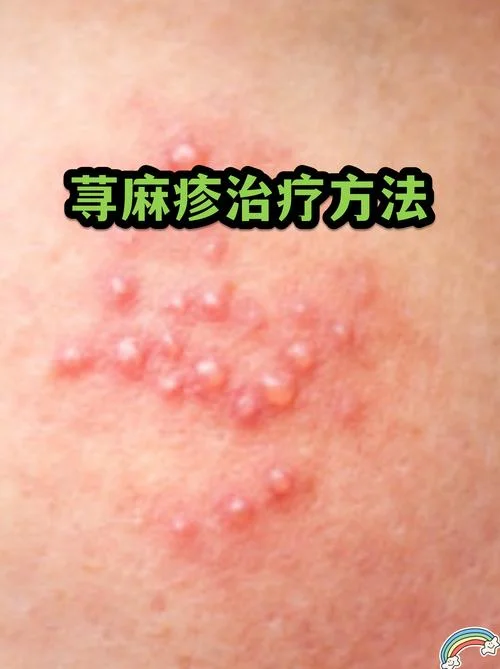 荨麻疹治疗要多少钱-荨麻疹治疗需多少钱