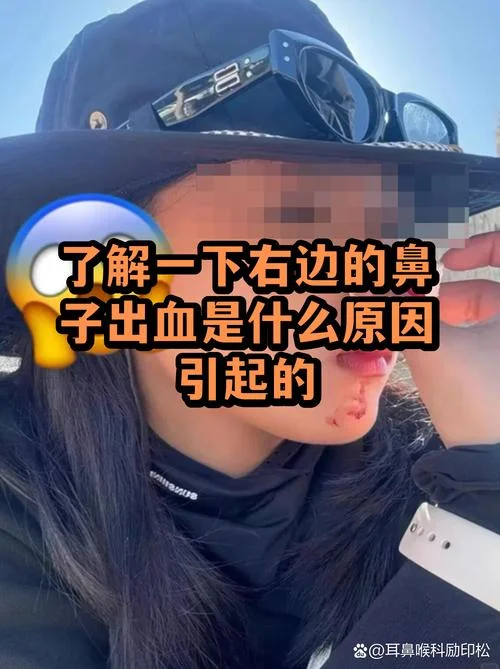 梦见鼻子流鼻血-梦到鼻出血