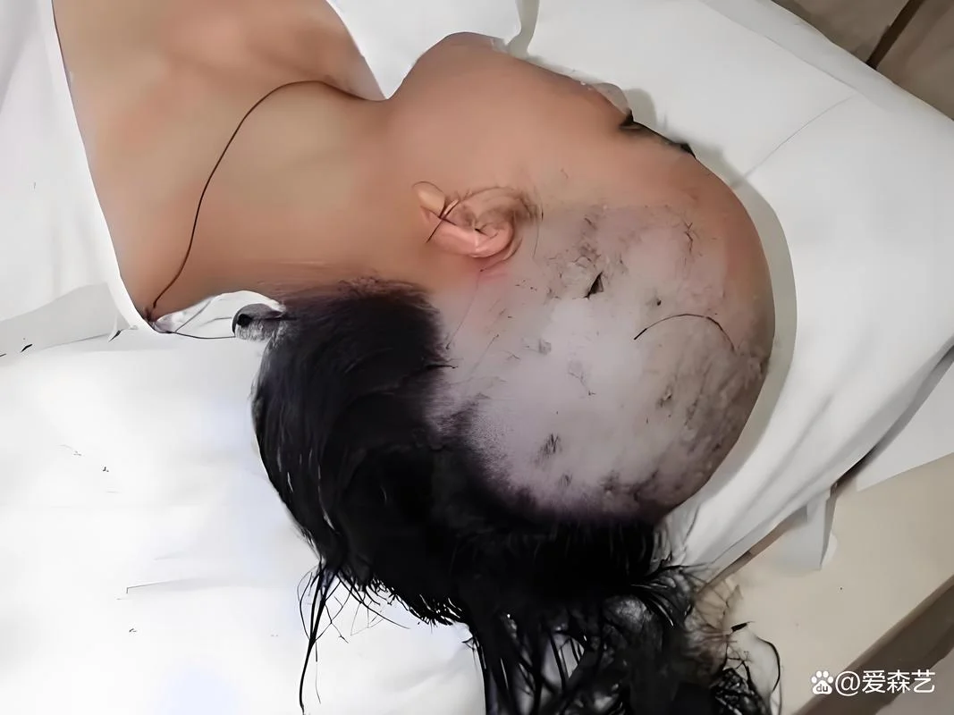 梦见自己剃光头皮破了_1