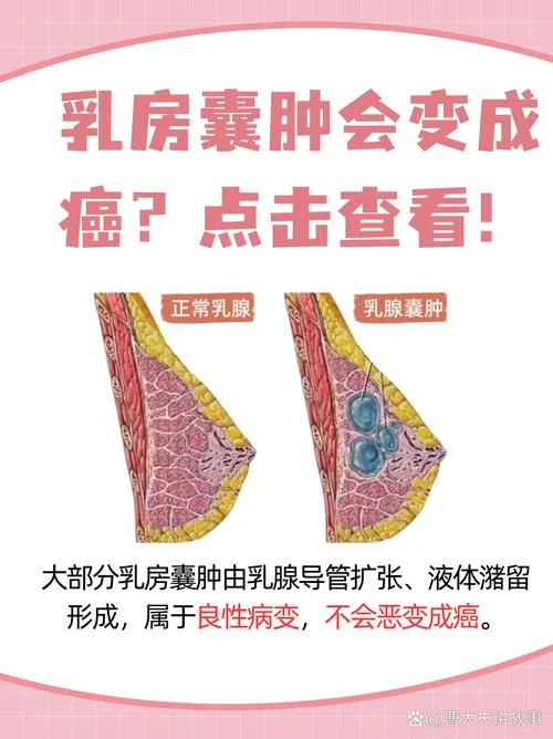 什么是乳腺腺瘤_2