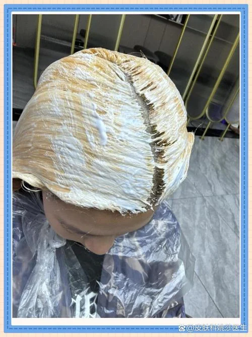 染发油脂性脱发怎么办-染发致油脂性脱发防