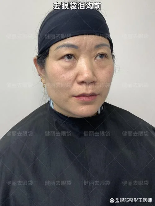 什么是韩式去眼袋_1