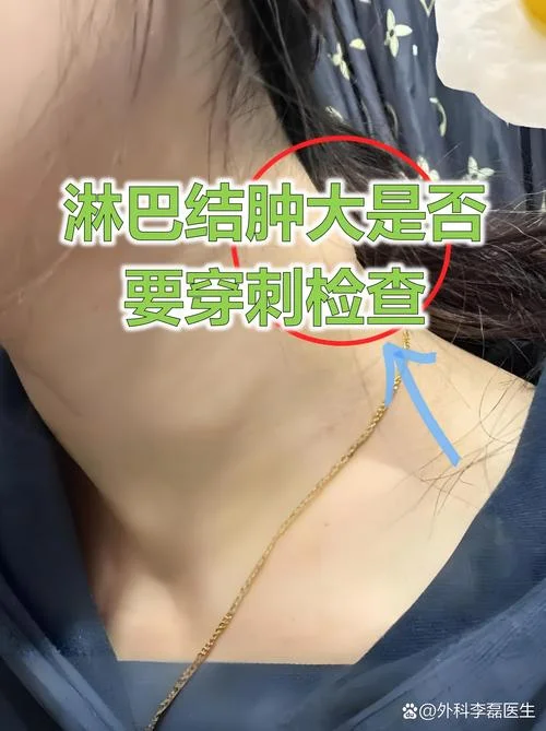 如何查淋巴瘤_1