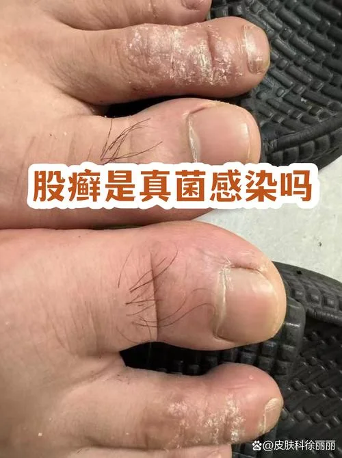 大腿两侧的癣叫什么癣_1