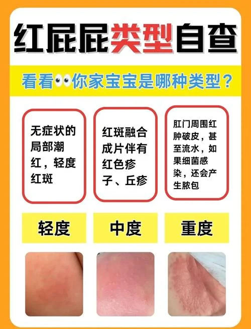宝宝屁屁红了破了怎么办_1