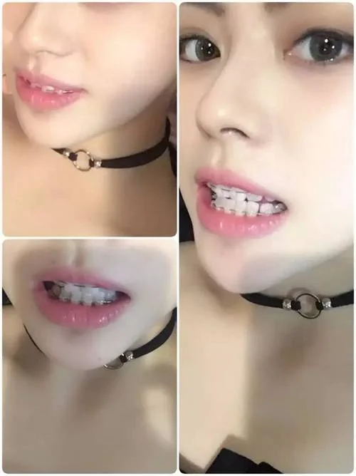 留学能带牙套吗-留学可戴牙套