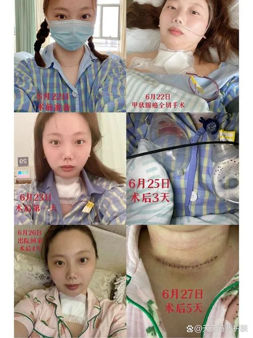 甲状腺术后的真实感悟_1