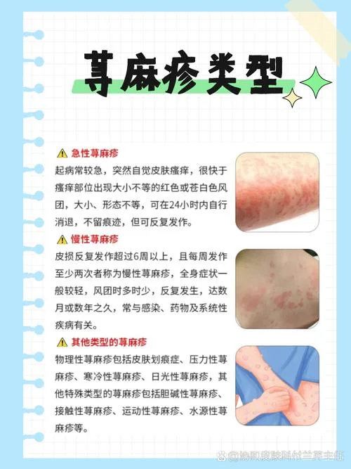 甲亢引起荨麻疹怎么办-甲亢致荨麻疹如何正确处理