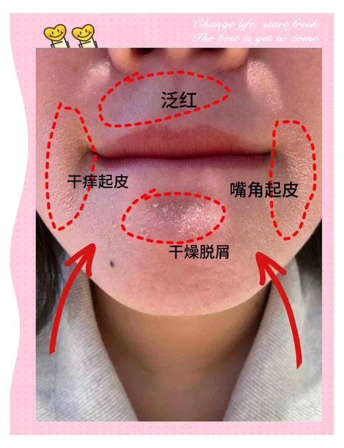 鼻子下干燥起皮怎么办-下鼻干燥皮裂
