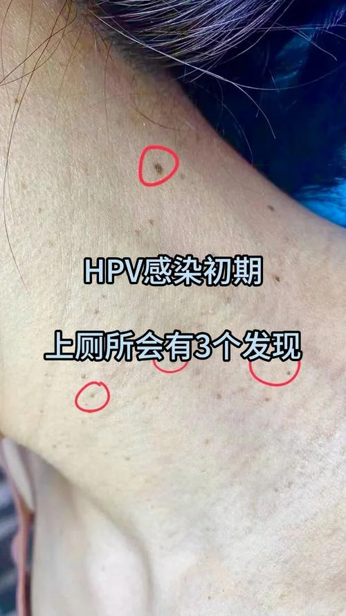 什么是hpv病毒感染图片_2