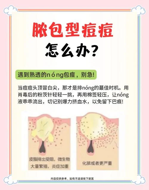青春痘有点疼怎么办-青春痘疼怎么办