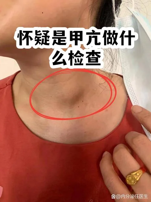 如何查甲亢引起的原因-甲亢病因如何查找