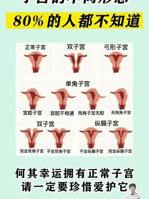 不完全纵隔子宫是什么意思_2