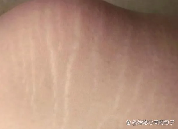 孕妇梦到自己长妊娠纹_1