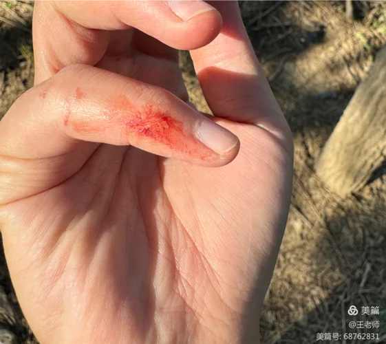 梦见自己手烂了一个洞_2