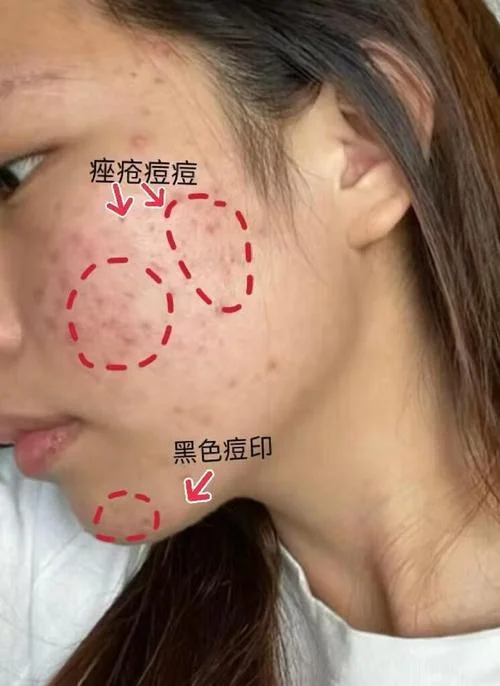 什么是痘印_2