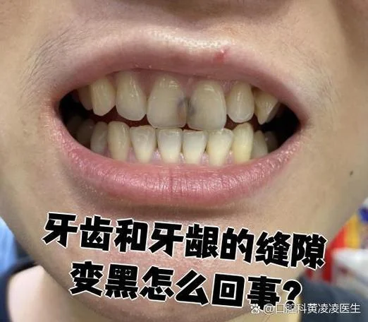 牙齿底下发黑是为什么_1