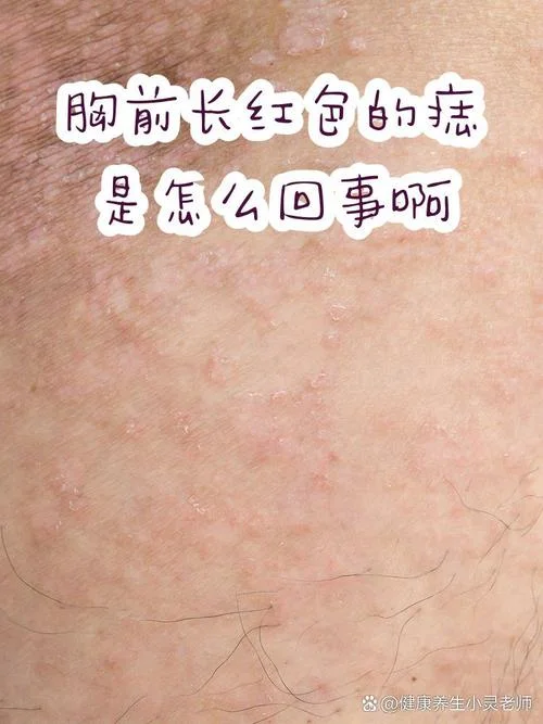 胸前长痣叫什么痣_1