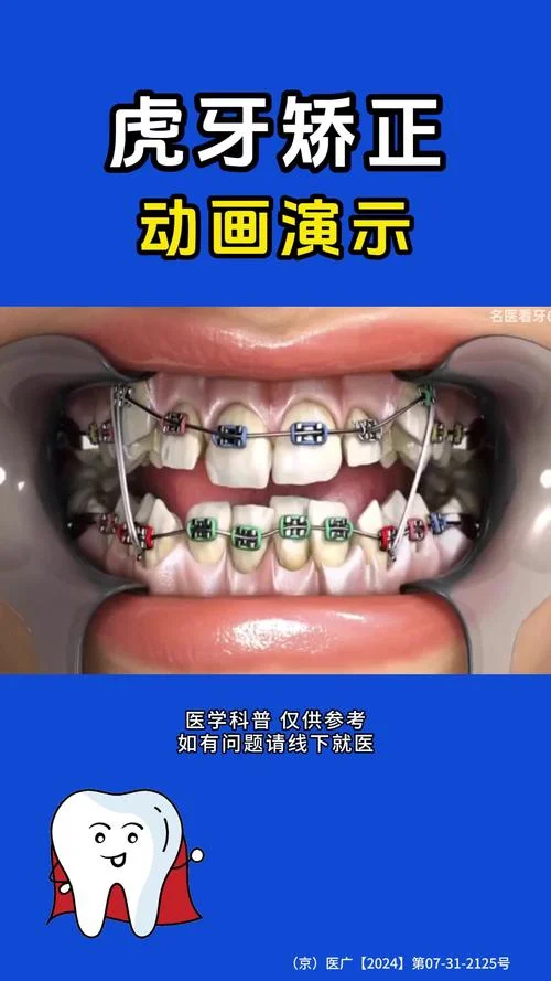 牙突出自我矫正方法_2