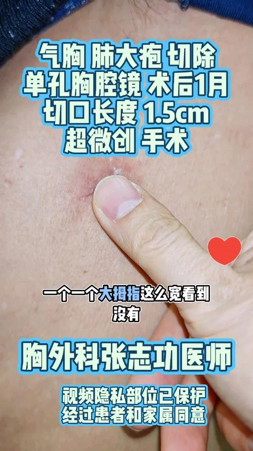 肺大泡破裂手术怎么做_2
