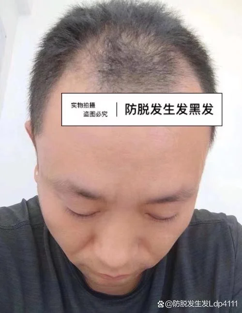 梦见自己头发前面秃了-梦前额脱发