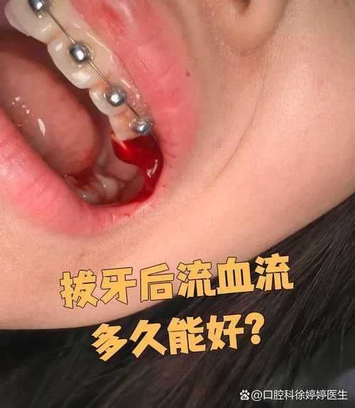 梦见掉牙流血还疼-梦掉牙流血疼痛