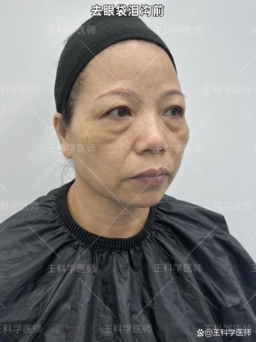 下眼睑的皱纹叫什么_1