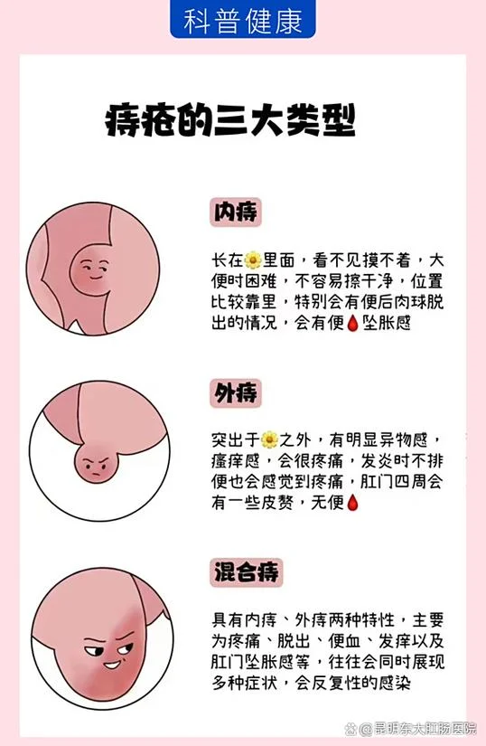 什么是痔疮初期_2