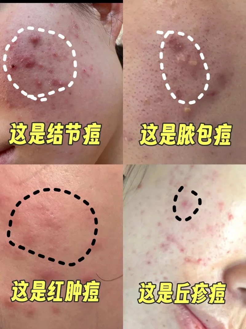 什么人会长青春痘-长痘人群有哪些