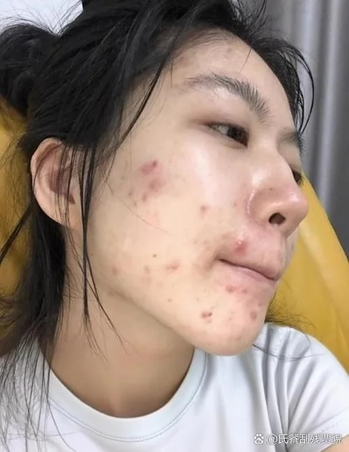 多大就不长痘痘了-多大不长痘了