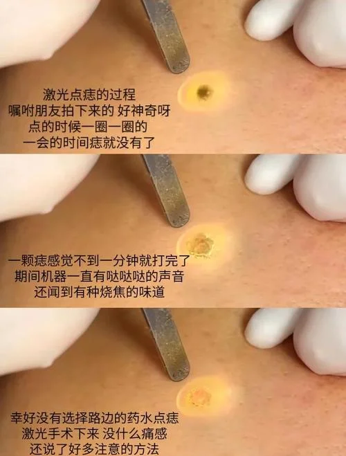 激光清楚雀斑的原理_1