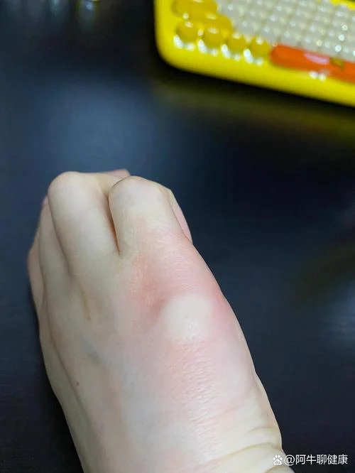 梦见被蚂蚁咬脚指_1