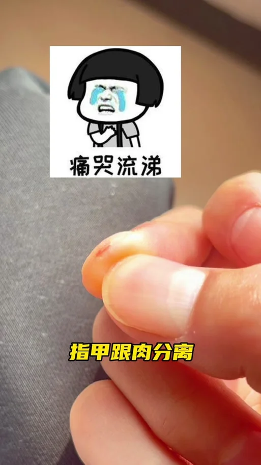 指甲盖和肉分离叫什么_1