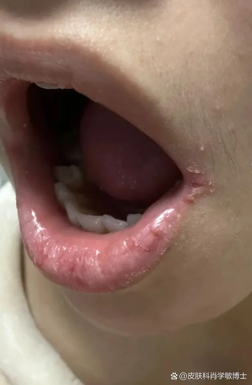 裂嘴角怎么办_2