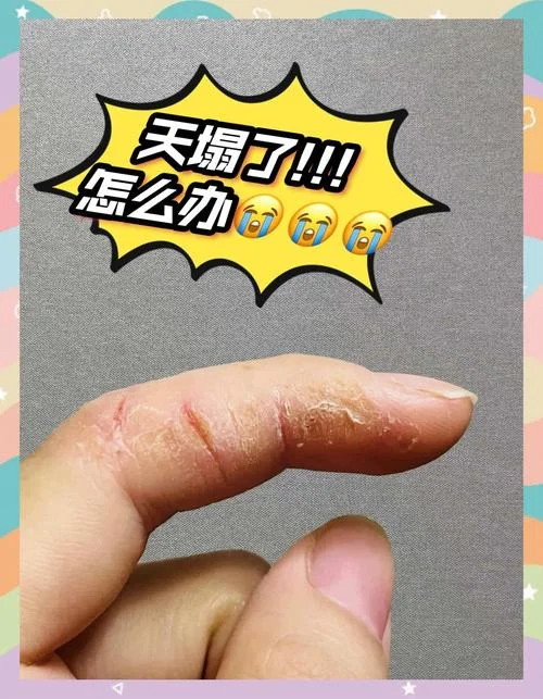 指纹裂开的是什么手相_2