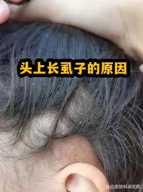 梦见头上有虱子掉下来-梦虱落头