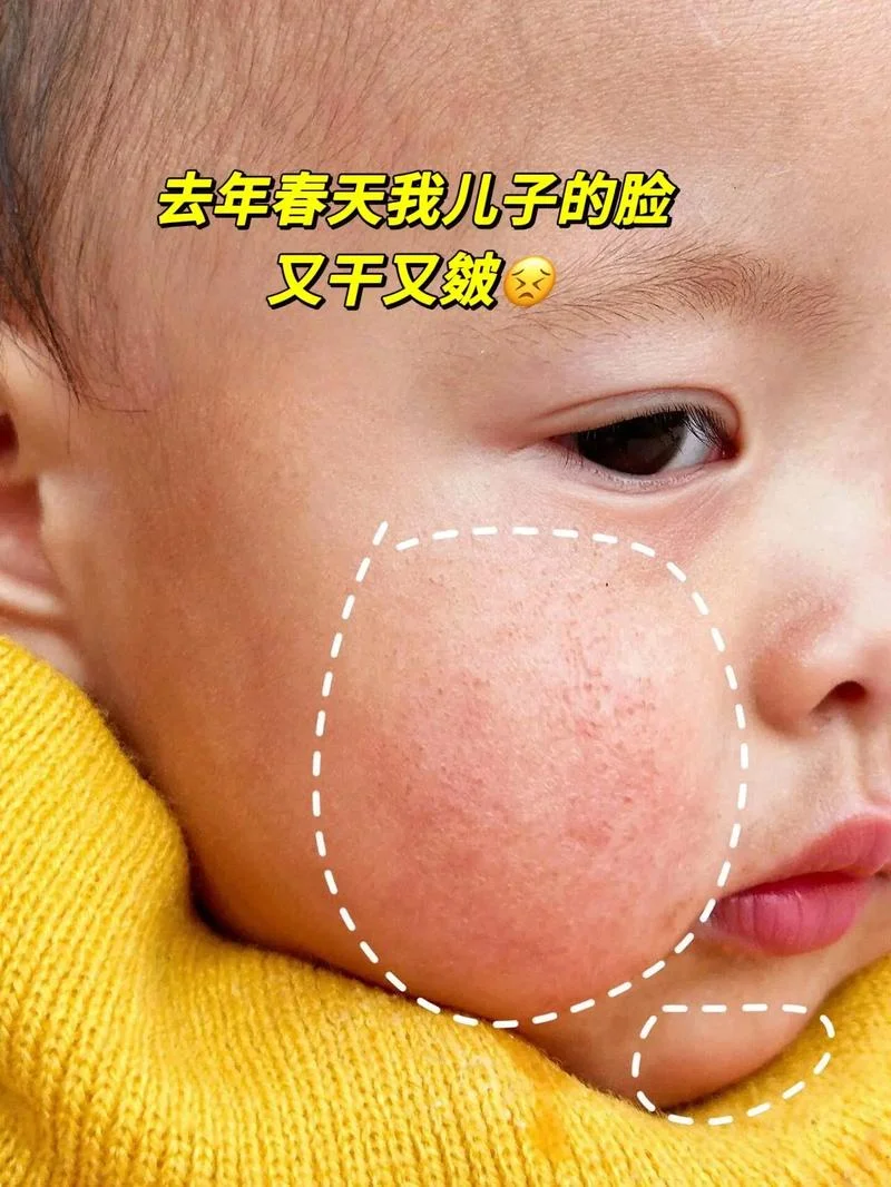 脸上蜕皮怎么办-脸上蜕皮怎么办