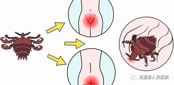 女性阴虱病症状怎么办用什么药_2