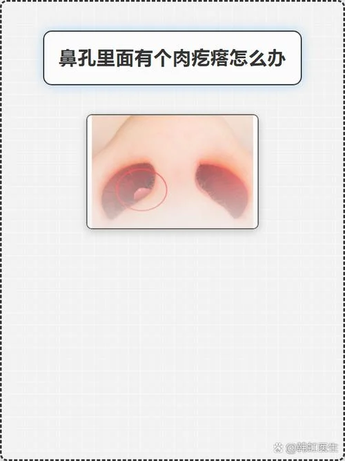 两个鼻孔间的肉叫什么_2