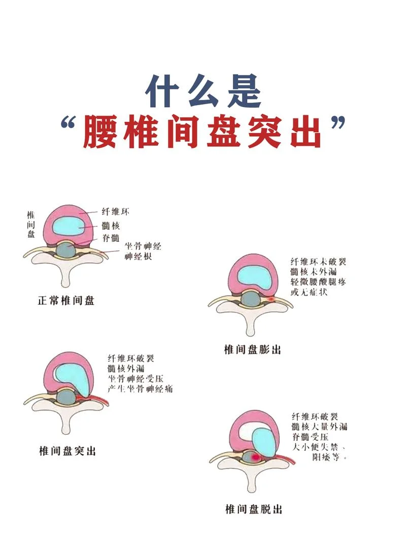腰间盘突出自己能好吗-腰椎间盘突出自愈需判断