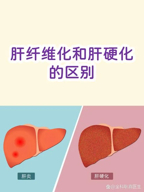 肝纤维化如何查_1