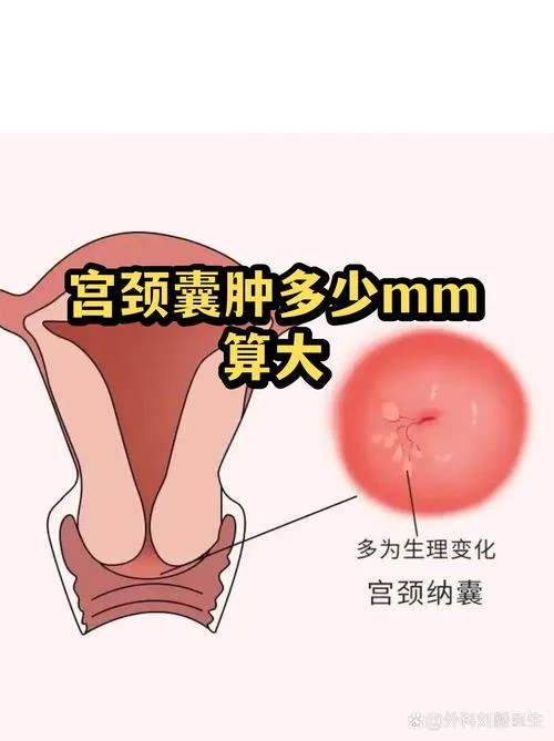 囊肿一年长多大_1