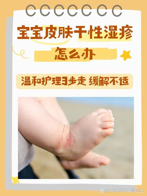 婴儿湿疹全身都是怎么办-婴儿湿疹全身怎么办