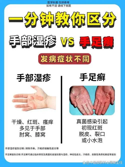 手掌湿疹中医原理_1