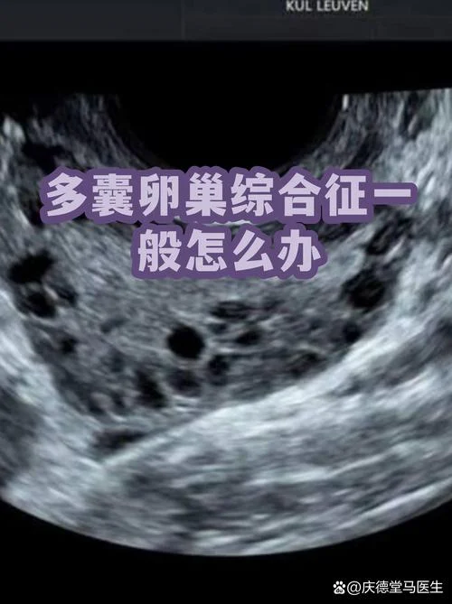 多囊性卵巢多毛怎么办-多囊卵巢多毛症治