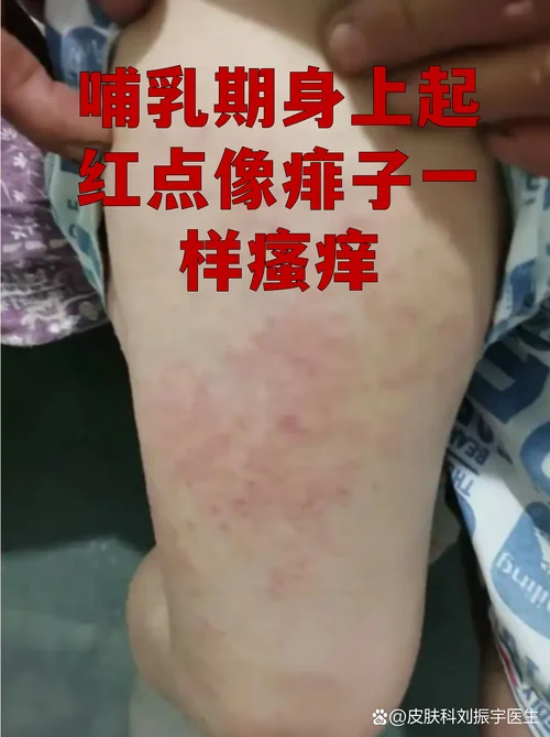 梦见孩子身上长满红点-梦孩子身长红点