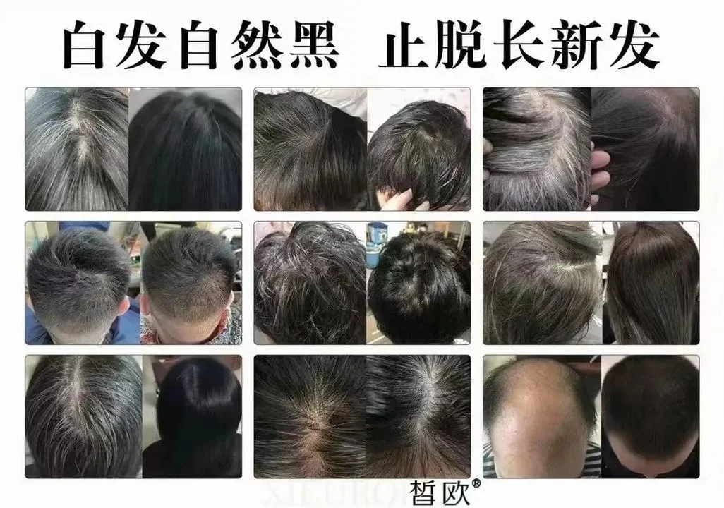 白发转黑发哪个品牌有效_1