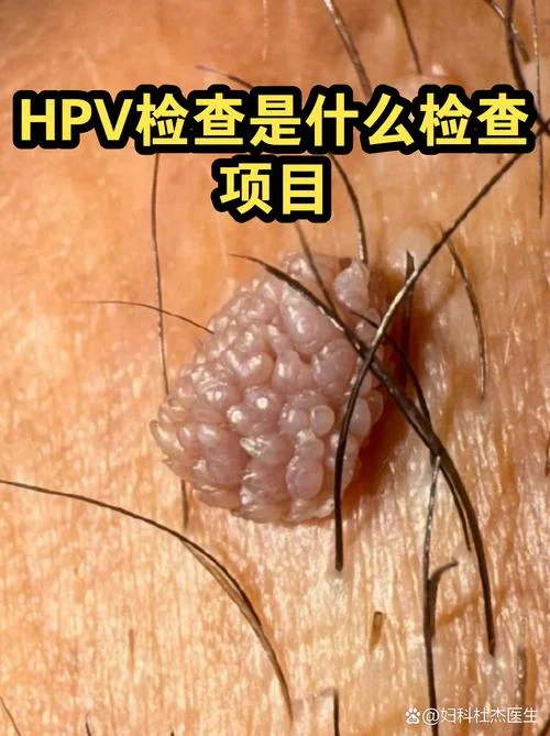 男性查hpv病毒在哪取样-男性查 HPV 病毒取样