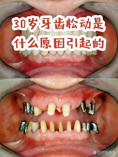 牙齿松动叫什么病_2