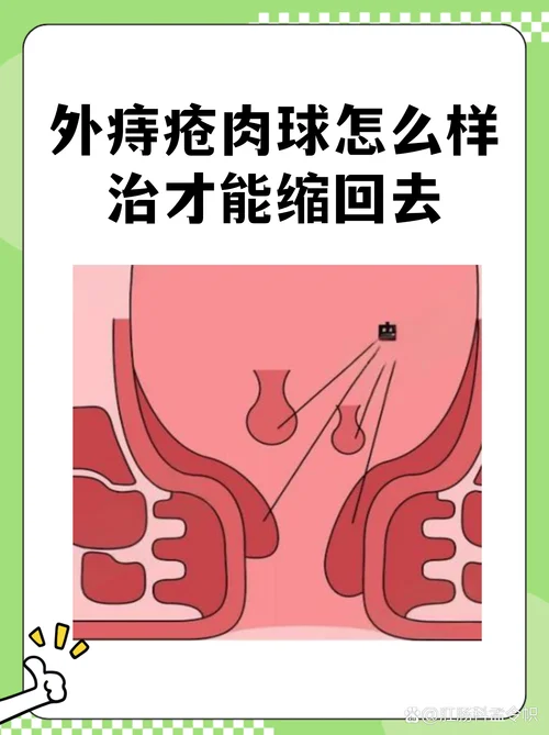 痔疮哪里治出自哪里_1